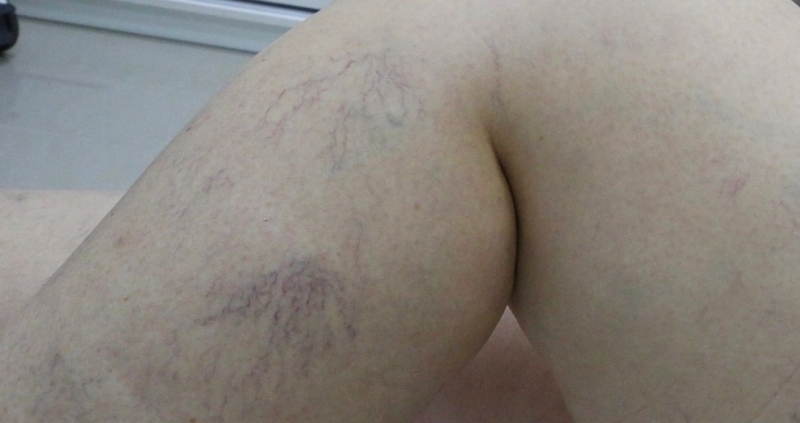 Hábitos que pioram as varizes (e você nem percebe)